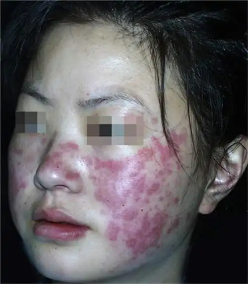 红斑狼疮面部早期症状图片