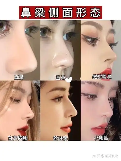 最全隆鼻术前沟通模板!自己适合哪种鼻型?鼻子存在哪些问题?