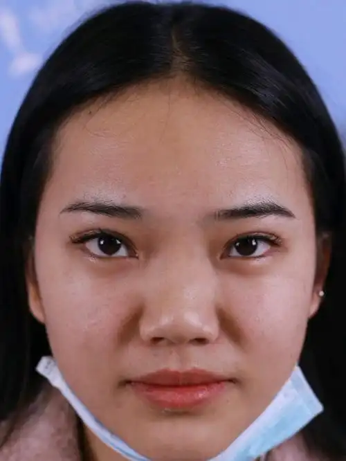 我的鼻子真的是一言难尽,鼻梁宽,又矮,就像没鼻子一_圈子-新氧美容