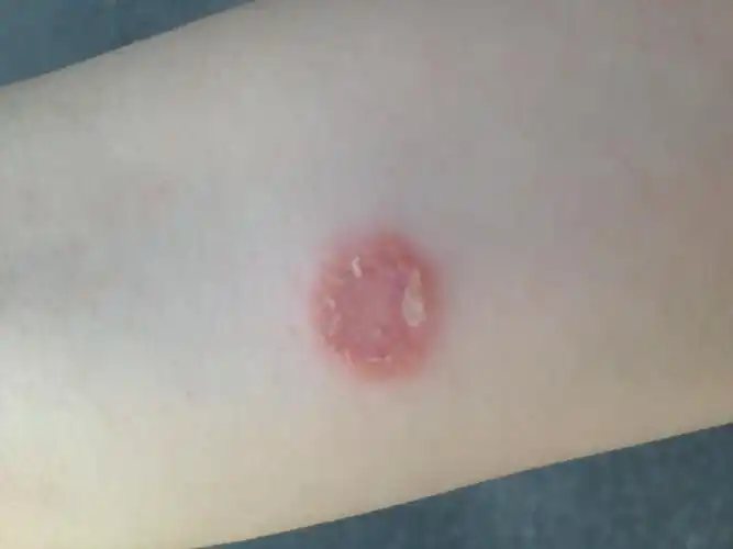 2013-09-01 21:21 提问者悬赏:10分|匿名|     分类:皮肤科 按默认