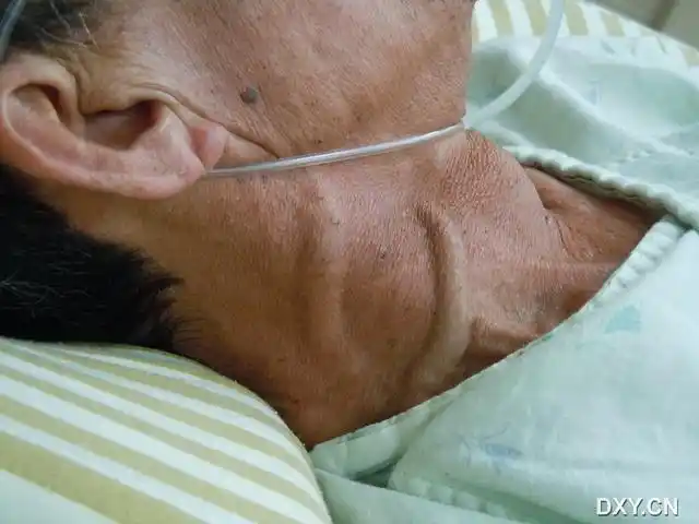 请问这两条是外颈与内颈静脉吗 走向好像怪怪的 [病例帖]