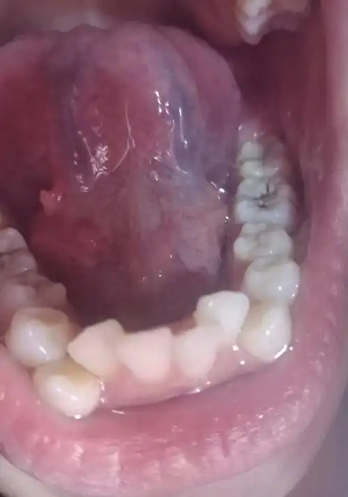 舌头下面长了个什么,帮帮忙,看看这是什么症状?