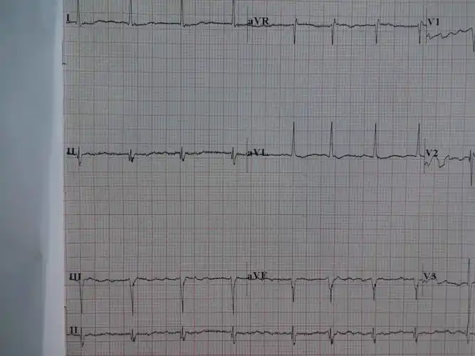 楼主cz19212013-04-07 16:13:05想请问一下这个心电图的诊断红线波浪
