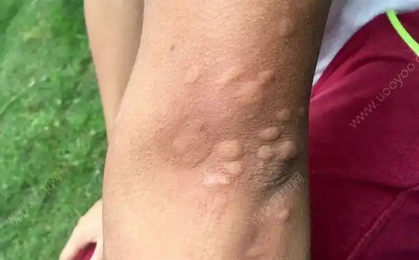 小黑虫叮咬后怎么办小黑虫子咬的包特别痒多图