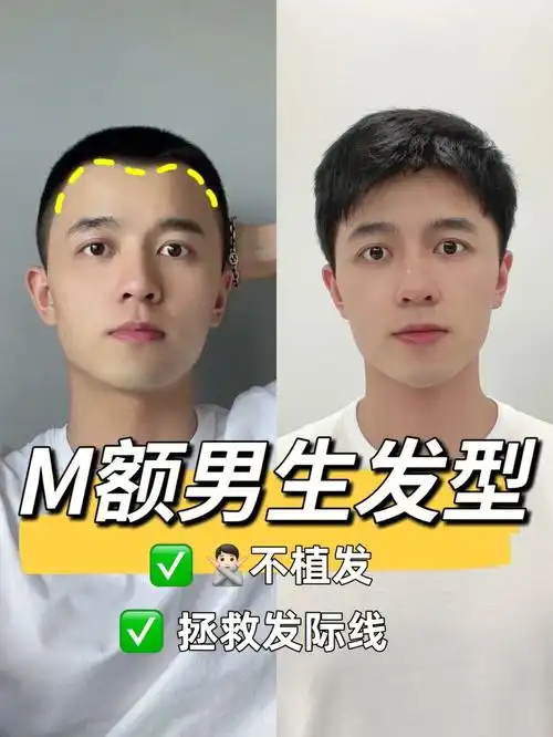 不植发拯救m额高发际线男生发型
