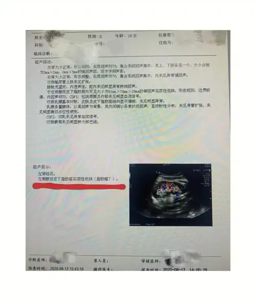 于是到医院检查,发现是一个脂肪瘤