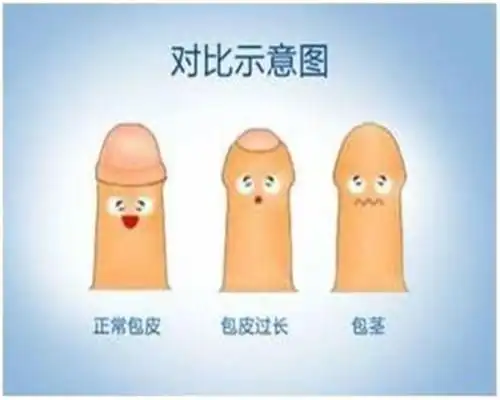 哪里有包皮包茎治疗医药保养阜新康健泌尿外科医院