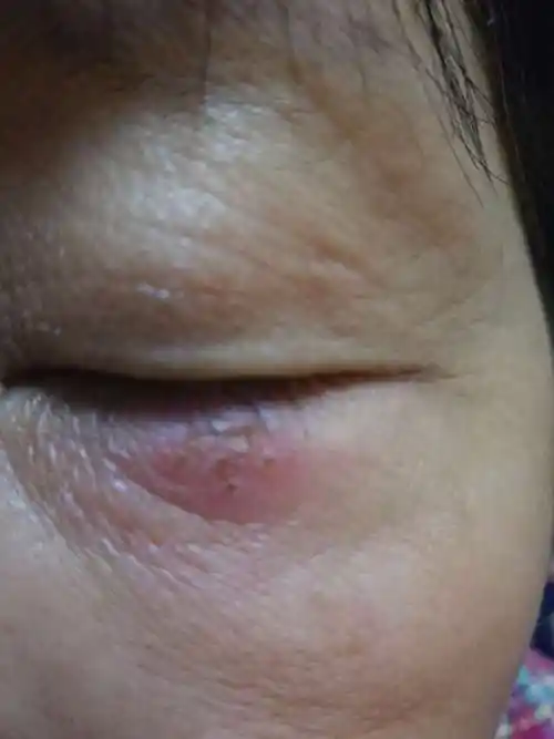 林医生您好我妈妈三天前早上起来发现眼睑下长个东西红肿