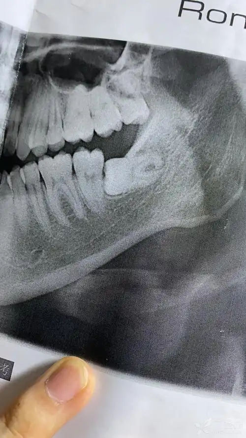口腔专业的学长学姐们,请问我左边这颗智齿拔的话风险很大吗
