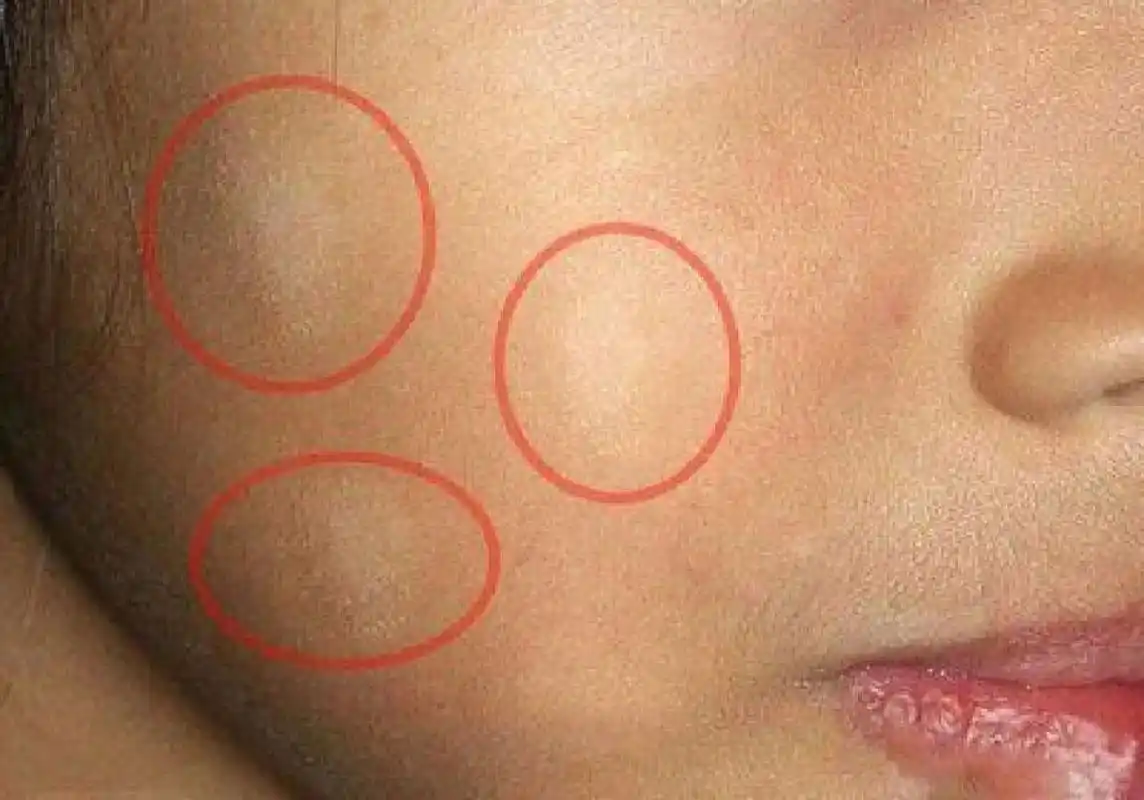 孩子脸上有白斑,很多家长的第一反应就是:"孩子怕是肚子里有虫吧"