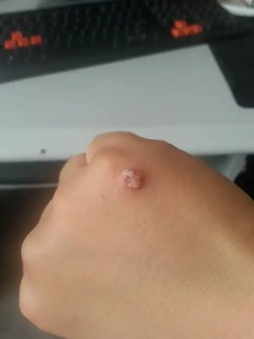 女朋友手上长个猴子,搞得心情很不好,咋样能快速去除,求各位指点,一定