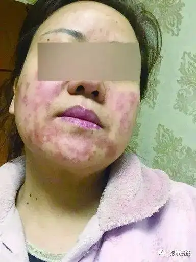 徐州一女子打水光针,涂了麻药脸又红又肿,一个多月都没好