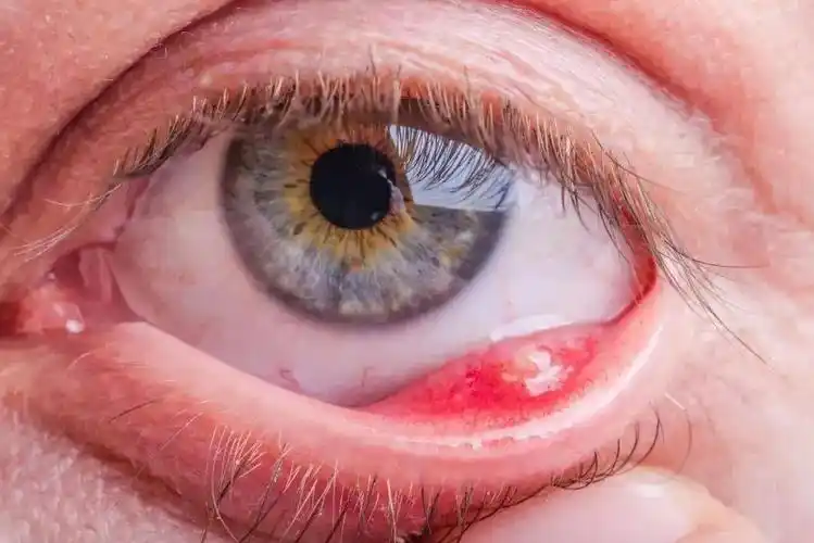 麦粒肿什么样子需要手术图片