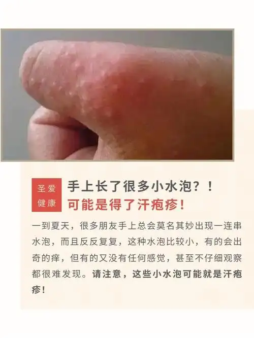 手上长了很多水泡瘙痒难忍小心是汗疱疹