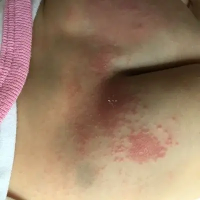 宝宝屁股红一片片的,这是痱子还是疹子呢?怎麼才能消啊?