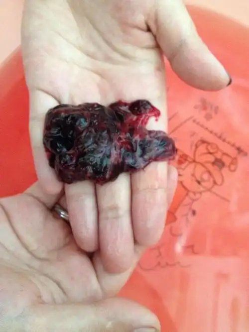 刚才上厕所掉下来的,这个是胎儿吗,不是应该是圆的吗,那这是什么