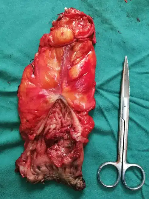 西平县中医院外二科/ 腹腔镜辅助下腹会阴联合低位直肠癌根治术/病历