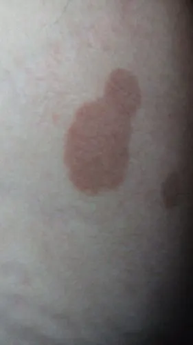 大腿内侧两边长了几块不均匀的斑块,外观呈淡紫红色,不痛不痒