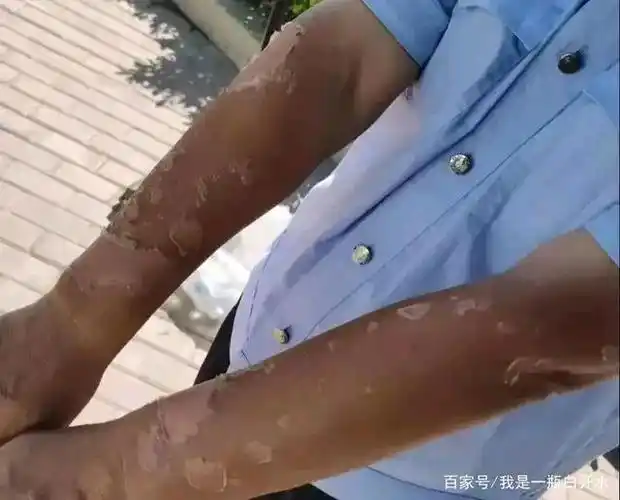 张海军被晒脱皮的一双胳膊