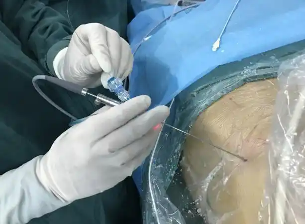 完成各类腔内碎石手术数百例,复杂尿路结石微创手术已经