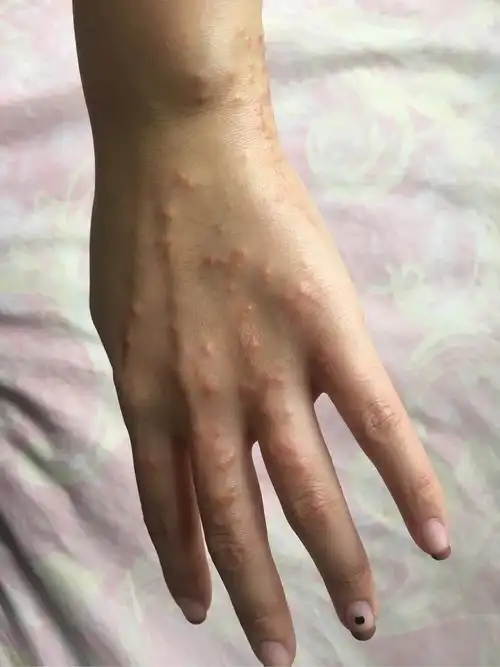 被地毯海葵蛰伤咬伤刺伤怎么办半个星期了一点好的意思都没