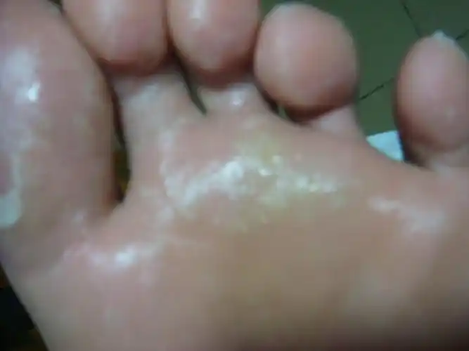 足底慢性湿疹图片