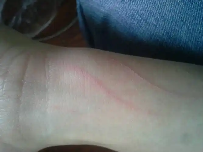 被狗爪子抓了两条红印,没出血,用酒精和硫磺皂处理过了,有一些细小的