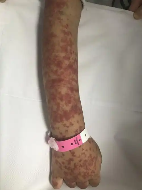 紫癜图片～2_小朋友