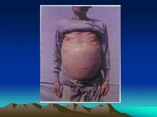 血吸虫病基本知识ppt