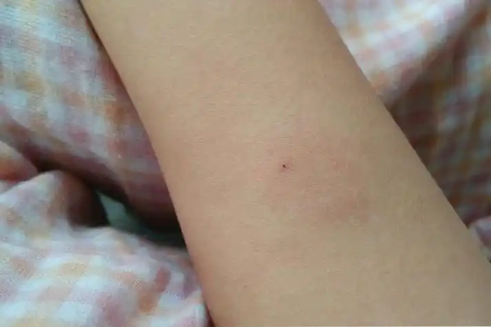 出现异常皮肤反应,具体表现如下:一般阳性( ):皮肤硬结的直径为5-9mm