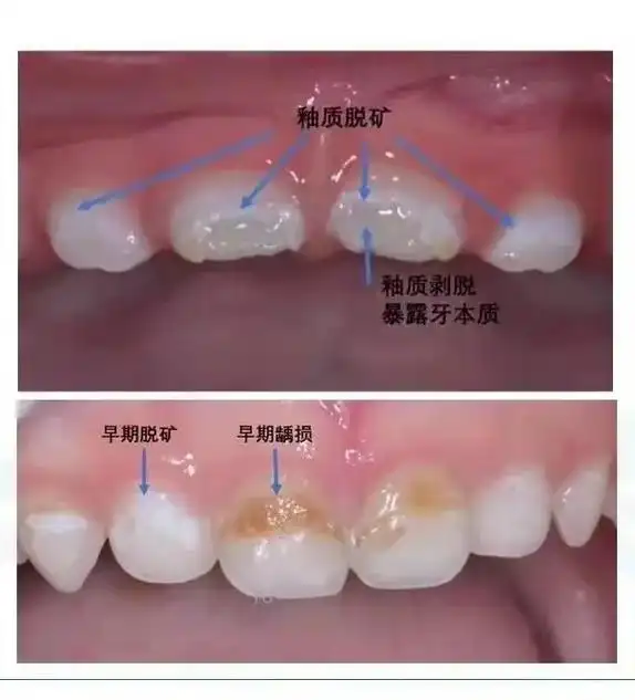 釉质脱矿釉质剥脱暴露牙本质早期脱矿早期 损不对称.