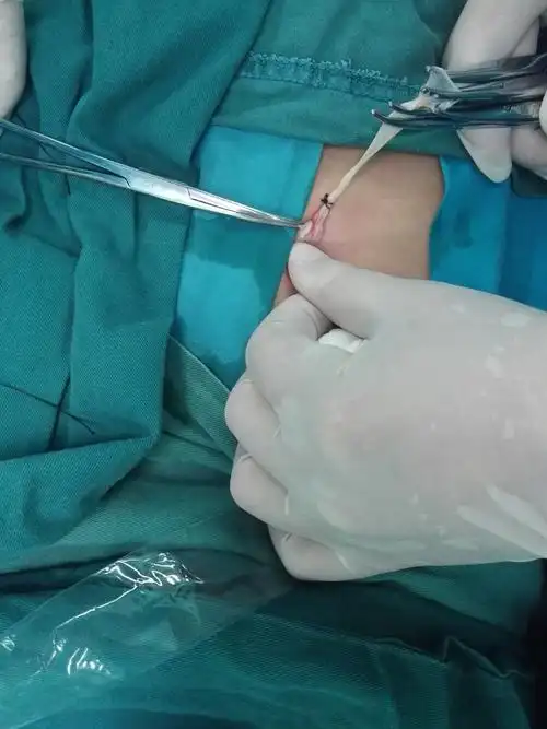 30上午在基础麻醉下行左斜疝疝囊高位结扎术 手术顺利完成,历时约5