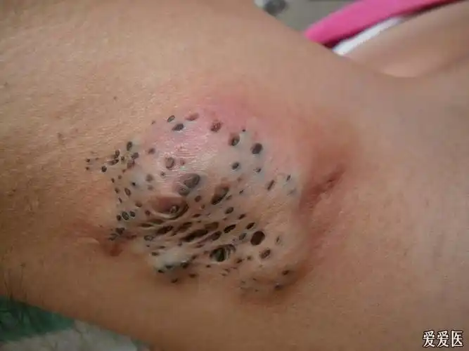 有奖猜答典型病例(21)公布答案-黑头粉刺痣,128人回答准确,已全部加分