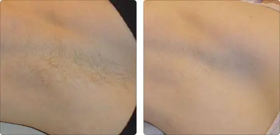 冰点脱毛好不好?