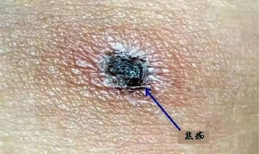 女孩被蜘蛛咬伤全身红肿起疹吓坏家长