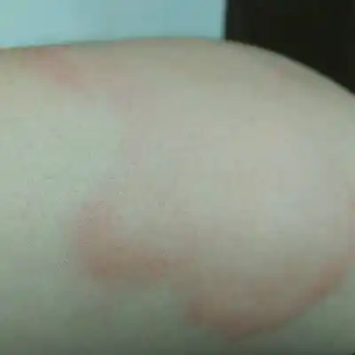 备孕提前三个月开始吃叶酸,买的金斯利安多维片,吃后过敏身上起红疙瘩