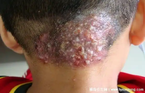 1,毛囊炎在初期是红色的小丘疹,跟痘痘十分相似,但是会比痘痘大很多