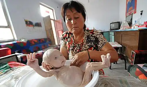 无肛男婴生命垂危 新生婴儿先天性肛门闭锁怎么回事呢?