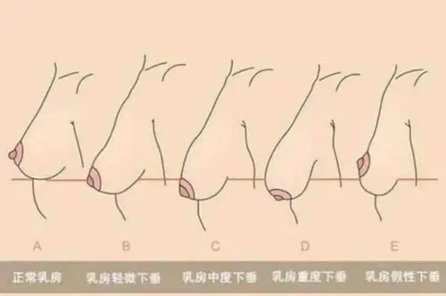 乳房下垂悬吊术—挽救产后胸部下垂