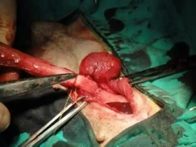 子宫脱垂怎样手术图片