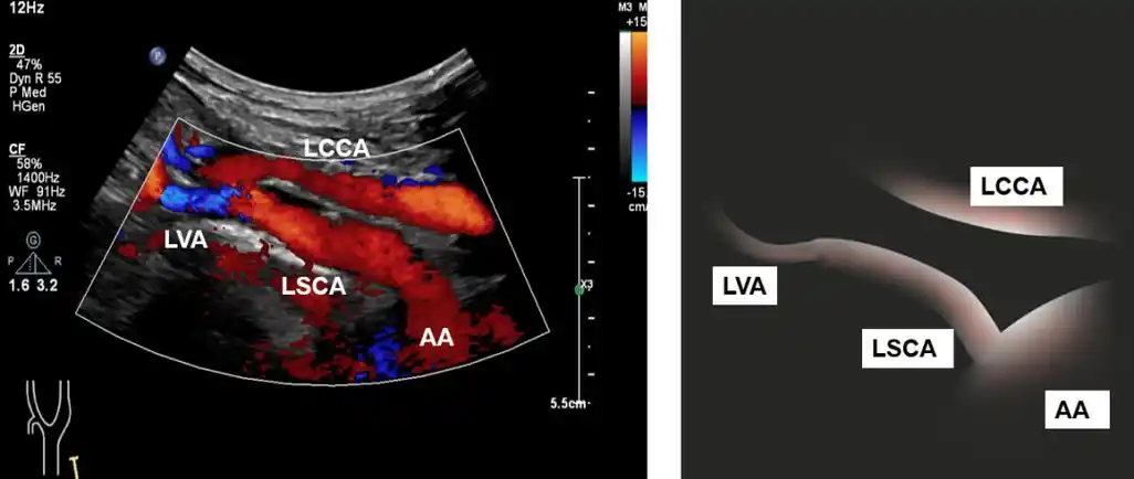 锁骨下动脉的超声扫查——解剖,分段,扫查方法与标准切面
