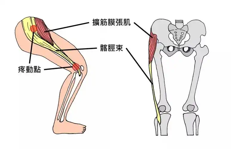 遭遇了髂胫束综合征该怎么办
