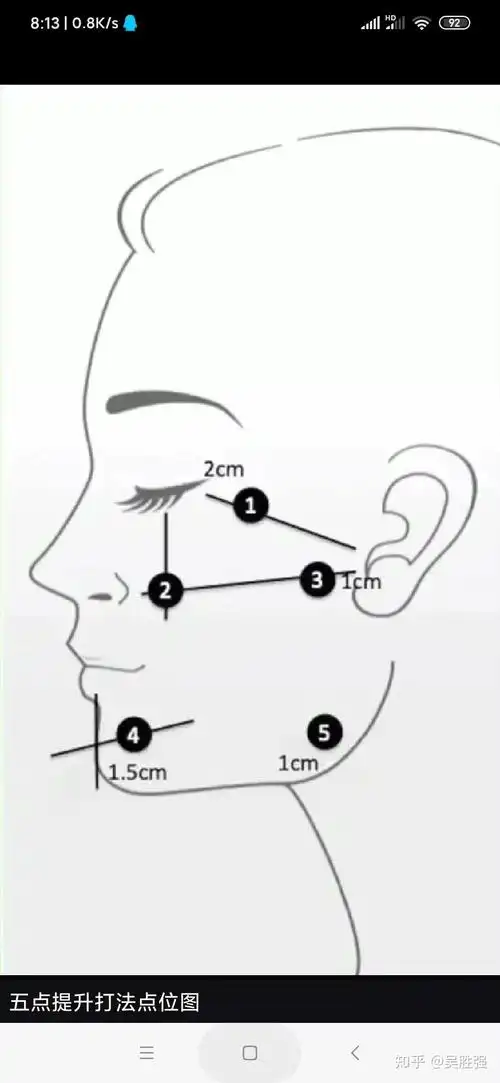 瑞士的新产品五点提升针是什么