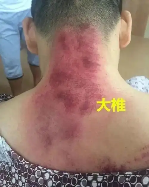 女性背部淤堵的表现「背厚跟背薄的区别图片」