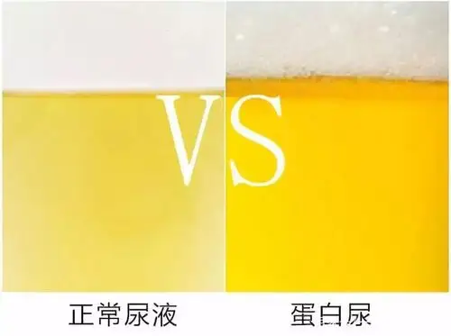 尿液能预示身体健康!你不妨自查看看