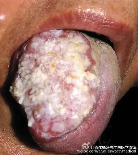 nejm 临床医学影像资料# 疣状舌病变(verrucous tongue lesion)  o