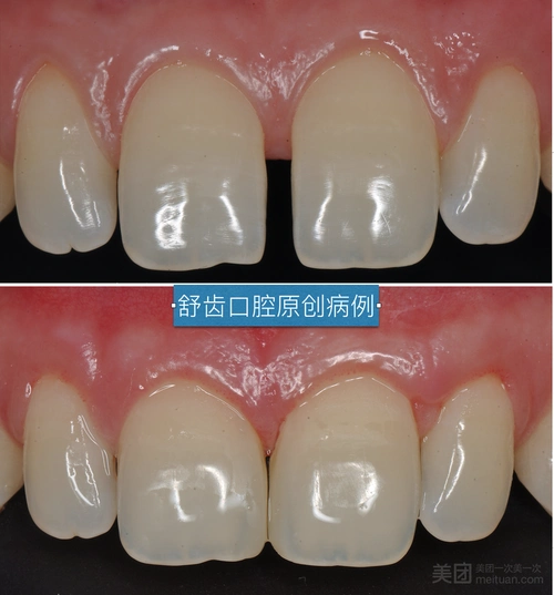 美国3mp60特硬树脂一颗