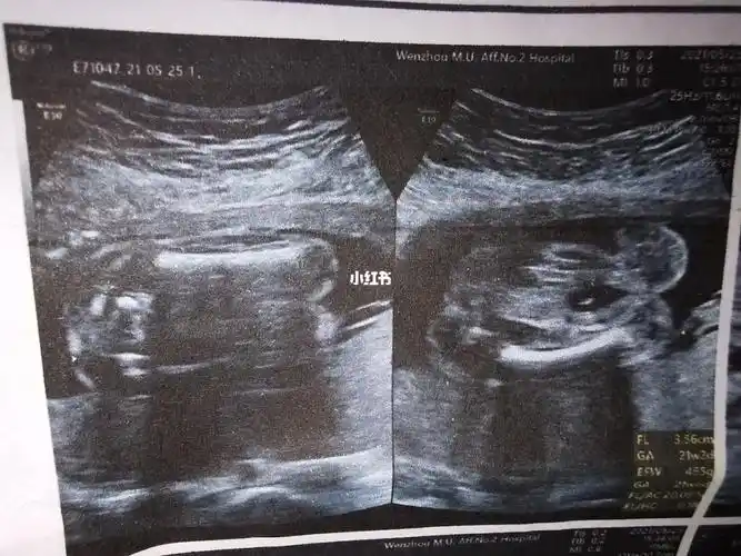 b超单看宝宝性别