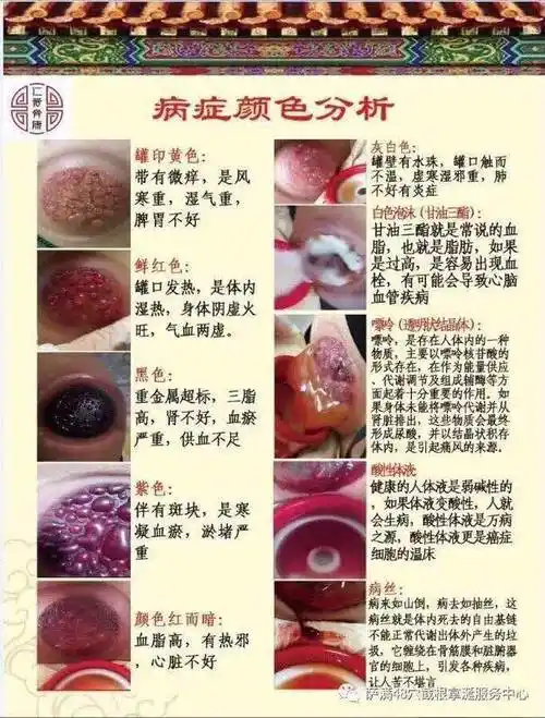 春草拔罐拿病让你的身体远离亚健康-在线订票-互动吧