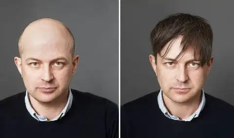 男生秃顶不好找对象戴假发丢人吗